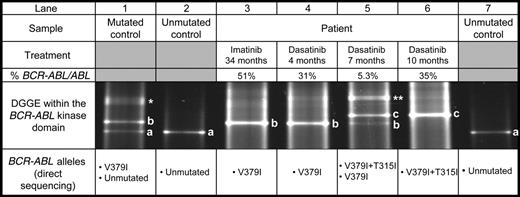Figure 1. DGGE follow-up of a CML patient treated successively by imatinib and dasatinib. A DGGE restricted to BCR-ABL RT-PCR fragments was performed for the patient (lanes 3-6), an unmutated control (lanes 2 and 7) and a V379I heterozygous mutated control (lane 1). Concerning the patient, the treatment, its duration, and the BCR-ABL/ABL ratio are shown. For each experiment, direct sequencing characterizes the BCR-ABL alleles. Letters in the DGGE profile indicate the homoduplex bands corresponding respectively to the BCR-ABL unmutated allele (a), the V379I BCR-ABL allele (b), and the V379I + T315I BCR-ABL allele (c). The asterisks (* and **) indicate the heteroduplexes, characteristics of the presence of 2 homoduplexes.