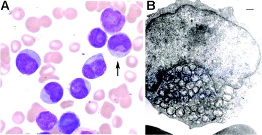 Figure 1. Morphologic features of AML with cuplike nuclei. (A) Blasts are medium-sized and have prominent nuclear invaginations, and scant to moderate cytoplasm with a few, fine azurophilic granules (Wright-Giemsa bone marrow aspirate smear; original magnification, × 1000). Image was obtained using an Olympus BX41 microscope (Olympus, Melville, NY) equipped with a 100×/1.25 numeric aperture oil objective; was acquired using a Spot Insight color camera 3.2.0 (Diagnostic Instruments, Sterling Heights, MI) and Image Pro Plus software version 3.2 (Media Cybernetics, Silver Spring, MD); and was processed using Adobe Photoshop CS version 7 (Adobe Systems, San Jose, CA). (B) Condensed collections of mitochondriae are present within the invaginated nuclear pockets (transmission electron microscopic examination; scale bar indicates 500 nm). Image was obtained using a JEOL 1200 EXII electron microscope (JEOL, Tokyo, Japan) at 20 000× magnification, and was processed using Adobe Photoshop CS version 7.