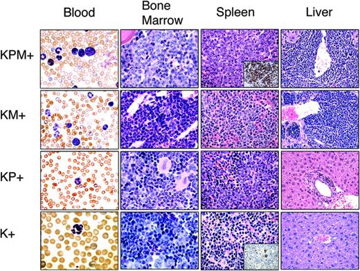 Figure 2. KPM+ mice coexpressing oncogenic K-ras and PML-RARα develop a lethal APL-like disease. Representative peripheral blood (1000× original magnification), bone marrow (1000× original magnification), spleen (400× original magnification), and liver (400× original magnification) histopathology from age-matched KPM+, KM+, nondiseased KP+, and K+ mice. Insets show representative myeloperoxidase immunohistochemistry of KPM+ and K+ spleen (400× original magnification). Note the predominance of immature mononuclear cells within the marrow and spleen of KPM+ mice compared to KM+, nondiseased KP+, and K+ mice.