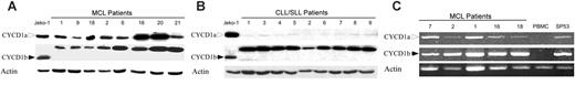 Figure 2. Expression of cyclin D1 isoforms by native MCL cells. MCL (A) and the control CLL/SLL (B) patient samples were examined for the expression of cyclin D1a (top rows; open arrowheads), cyclin D1b (middle rows; solid arrowheads), and actin (bottom rows) proteins with Jeko-1 MCL line serving as a positive control. (C) Expression by MCL cells of mRNA coding for cyclin D1a, cyclin D1b, and control actin. Results are representative of at least 3 independent experiments.