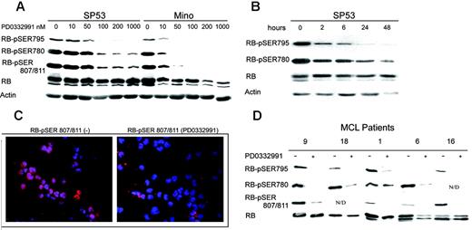 Figure 4. Effect of CDK4/CDK6 inhibitor on Rb phosphorylation in MCL cells. (A) SP53 and Mino MCL cell lines were exposed to the depicted concentrations of PD 0332991 for 2 hours and analyzed in Western blot for the Rb phosphorylation at serines 795, 780, and 807/811. (B) Kinetics of Rb dephosphorylation in the presence of PD 0332991 at 50 nM. (C) Visualization of the Rb phosphorylation at serine 807/811 in the MCL cells by immunofluorescence before (left panel) and after (right panel) 16-hour exposure of Mino cells to 100 nM PD 0332991. (D) Rb phosphorylation at the depicted serine moieties in patient-derived primary MCL cells after 1-hour exposure to 200 nM PD 0332991. N/D indicates not done. Results are representative of at least 3 independent experiments.