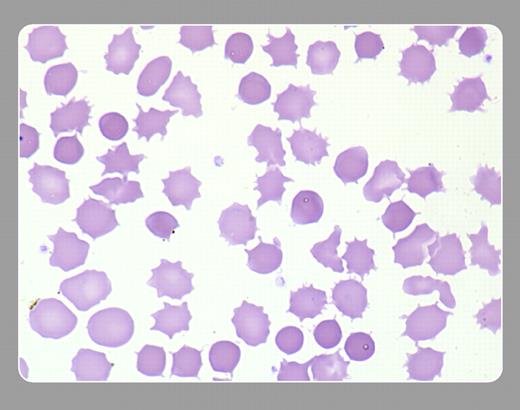 Figure 1. Acanthocytes are red cells that have a spherical core and a spiculated appearance. A typical acanthocyte lacks central pallor and has from 3 to 12 “spikes” or “knobs.” They can be seen in advanced liver disease (where they are referred to as spur cells), abetalipoproteinemia, and, occasionally, after splenectomy. . / Peter Maslak, Memorial Sloan-Kettering Cancer Center