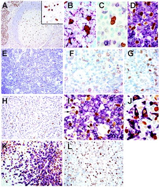 Figure 1. Immunohistochemical analysis of C/EBPβ expression in normal lymphoid tissue and in different lymphoid neoplasias. (A) C/EBPβ protein expression in normal lymphoid tissue (tonsil). In the germinal center, mantle zone, and interfollicular T-cell area, C/EBPβ is strongly expressed in the nuclei of scattered cells, whereas most surface epithelial cells express high levels of C/EBPβ. Immunoperoxidase (IP) stain, 100×. C/EBPβ-positive cells within the germinal center correspond to follicular dendritic cells (inset; IP stain, 400×). (B) Double staining for C/EBPβ (brown) and clusterin (purple) reveals that the C/EBPβ-positive germinal center cells express the dendritic cell marker clusterin. Note also that the clusterin stain highlights the dendritic cell processes. IP stain, 650×. (C-D) Double staining for C/EBPβ (brown) and CD3 (purple) (C) or CD20 (purple) (D) in the germinal center demonstrates that the CD3+ T cells and CD20+ B cells are negative for C/EBPβ. IP stain, 650×. (E) C/EBPβ expression in mantle cell lymphoma. The neoplastic cells are negative, whereas the intratumoral histiocytes are positive and serve as an internal positive control. IP stain, 100×. (F-G) C/EBPβ in 2 cases of classic Hodgkin lymphoma. Faint nuclear reactivity is seen in the Reed-Sternberg cells in 1 case (G), whereas the second case (F) shows no C/EBPβ expression. In both cases, abundant histiocytes are strongly positive for C/EBPβ. IP stain, 650×. (H) C/EBPβ expression in unspecified PTCL. Neoplastic cells are negative, whereas intratumoral histiocytes are positive. IP stain, 100×. (I-J) C/EBPβ expression in a second case of unspecified PTCL. (I) Double staining for C/EBPβ (brown) and CD3 (purple) demonstrates that a small population of the neoplastic T cells (arrows) shows weak nuclear staining for C/EBPβ. In contrast, compare the strong nuclear positivity of the reactive histiocytes. IP stain, 400×. (J) Double staining for C/EBPβ (brown) and CD68 (purple) confirms the histiocytic origin of the strong C/EBPβ-positive cells. IP stain, 650×. (K) Unspecified PTCL with abundant histiocytes. Double staining for C/EBPβ (brown) and CD3 (purple) demonstrates that C/EBPβ is not expressed in the CD3+ tumor cells. IP stain, 100×. (L) C/EBPβ expression in ALCL, ALK-negative, with weak nuclear staining in tumor cells. In contrast, reactive histiocytes showed strong nuclear positivity with C/EBPβ. IP stain, 250×. Images were acquired using a Hitachi camera HW/C20 (Hitachi, Tokyo, Japan) installed in a Zeiss Axioplan microscope (Zeiss, Jena, Germany) using Intellicam software. Plan-Neofluar 10×/0.30 numeric aperture (NA), 20×/0.50 NA, and 40×/0.75 NA objectives as well as a Plan-Apochromat 63×/1.40 oil objective were used. Images were processed using Adobe Photoshop (Adobe Systems, San Jose, CA).
