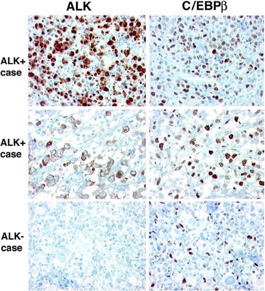 Figure 2. ALK and C/EBPβ immunostaining in ALCL. The 2 ALK-positive cases, with nuclear (top) and cytoplasmic (middle) expression, show strong nuclear positivity in most tumor cells for C/EBPβ. The ALCL, ALK-negative case (bottom) is negative for C/EBPβ; however, the reactive histiocytes are strongly positive and serve as internal control. IP stain, 400×. Images were otherwise acquired as explained in Figure 1.