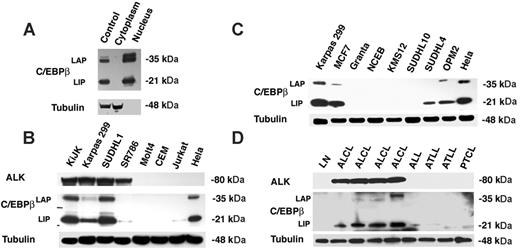 Figure 3. Western blot analyses for C/EBPβ and ALK in lymphoid cell lines and primary lymphoma cases. (A) Subcellular fractionation of the SUDHL-1 cell line. Tubulin is used as control for loading and for the cytoplasmic fraction. (B) KiJk, Karpas 299, SUDHL1, and SR786 represent ALCL cell lines with the t(2;5) translocation. The non-t(2;5) T-cell lines are Molt4, CEM, and Jurkat. Tubulin is used as loading control. (C) Western blot analysis in B-cell lymphoid cell lines including 2 mantle cell lymphoma lines (Granta 519 and NCEB-1), 2 multiple myeloma cell lines (KMS12 and OPM2), and 2 follicular lymphoma cell lines (SUDHL4 and SUDHL10). The ALCL cell line Karpas 299 and the 2 carcinoma cell lines MCF7 and HeLa are used as controls. Tubulin is used as loading control. (D) Western blot analysis in primary T-cell lymphoma cases including 1 normal lymph node (LN), 4 primary ALK-positive (ALCL) lymphomas, 1 acute lymphoblastic leukemia (ALL), 2 adult T-cell leukemia/lymphoma (ATLL), and unspecified PTCL. Tubulin is used as loading control.