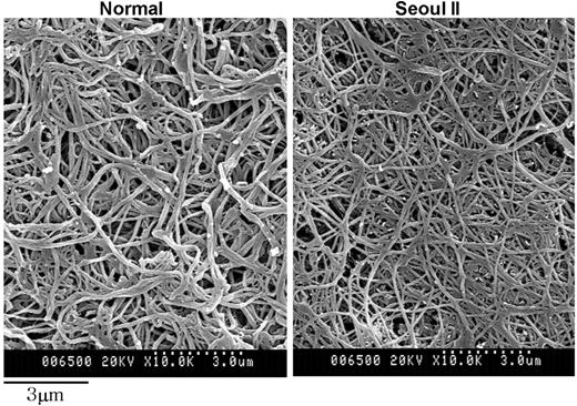 Figure 6. Scanning electron microscopy of fibrin clots. Scanning electron microscopy images of heterozygous Seoul II fibrin clots (right) and normal fibrin clots (left) are shown. Heterozygous Seoul II fibrin clot showed thinner fibers than normal control (bar equals 3 μm).
