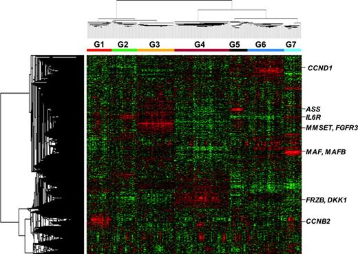 Figure 1. Gene expression patterns in malignant plasma cells reveals that myeloma consists of 7 subgroups. Two-dimensional unsupervised hierarchic cluster analysis of 1559 highly variable genes (rows) in CD138-enriched plasma cells from 256 newly diagnosed multiple myeloma cases (columns). A mean-centered gene expression is depicted by a normalized-signal pseudocolor scale. Red and green indicate overexpressed and underexpressed genes, respectively. The sample dendrogram at the top and gene dendrogram to the side reflect the relatedness of the samples. Note that the dendrogram branches are strongly influenced by noticeable clusters of overexpressed genes. Subgroup designations 1 through 7, from left to right, are indicated under the dendrogram. Subgroup-specific gene clusters are indicated by colored bars to the right of the dendrogram.