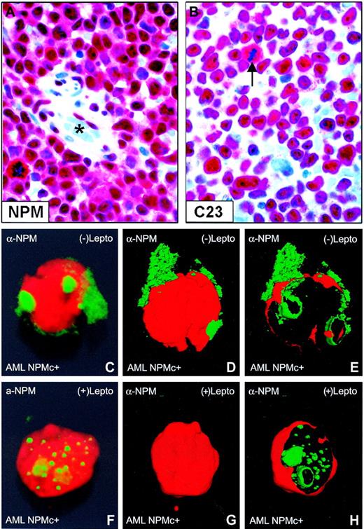 Figure 1. Nuclear relocation of NPM by leptomycin B in primary NPMc+ AML cells. (A-B) Bone marrow from an NPMc+ patient with AML bearing NPM mutation A. (A) Leukemic cells show cytoplasmic (in addition to nuclear) expression of NPM; endothelial cells of a vessel (lumen indicated with an asterisk) show nucleus-restricted NPM (Olympus 100×/1.3 NA UPlanFl oil objective). (B) Leukemic cells, with the exception of a mitotic figure (arrow), show the expected nucleus-restricted expression of C23/nucleolin (Olympus 100×/1.3 NA UPlanFl oil objective). (C-E) Purified leukemic cells from the patient were immunostained with a monoclonal anti-NPM antibody (clone 376) and observed at the confocal laser microscope (100×/1.4 NA PlanApochromat oil objective). Images were reconstructed in 3 dimensions, and an electronic cut of the nuclear surface was performed to better analyze the localization of NPM. The antibody 376, which cannot distinguish between the wild-type and NPM mutant A proteins (both contained in the leukemic cells), labels both nucleoli and cytoplasm in the absence of LMB. (F-H) Incubation with LMB results in nucleoplasmic relocation of cytoplasmic NPM.