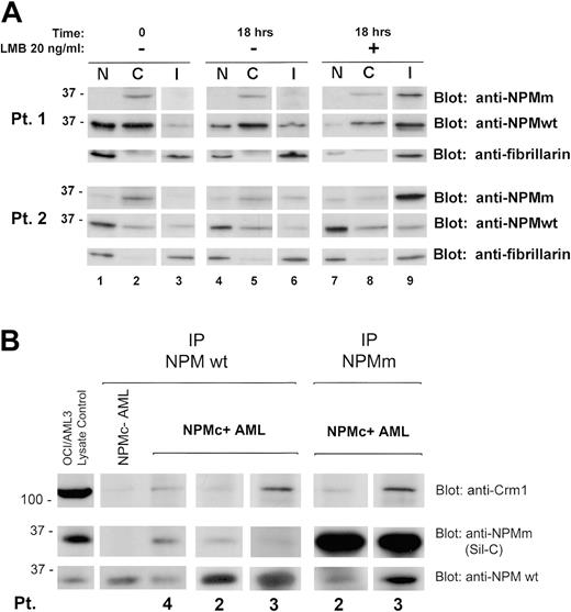 Figure 2. NES-dependent altered nucleocytoplasmic traffic of NPM in NPMC+ AML. (A) Subcellular distribution of wild-type and mutant NPM in NPMc+ AML cells. Data of experiments on 2 NPMc+ AML patients are shown. The anti-NPMm blotting (both patients, top panels) shows accumulation, upon LMB treatment, of NPM mutant protein in the insoluble fraction (I) (both patients, lane 9, top panels). Relocation, upon LMB treatment, of NPM wild-type protein in the same fraction was demonstrated by blotting the membrane with an anti-NPMwt–specific antibody (both patients, lane 9, middle panels). The insoluble fraction represents mainly subcellular fraction containing most of the nucleolar compartment, as assessed by stripping the membrane and reblotting for the nucleolar marker fibrillarin (both patients, bottom panels, lanes 3, 6, and 9), and possibly other insoluble nuclear structures. NPMm indicates mutated NPM; NPMwt, wild-type NPM. (B) Interaction between wild-type NPM, leukemic NPM mutants, and Crm1 in NPMc+ AML cells. Cell lysates from either NPMc– or NPMc+ AML patients were subjected to immunoprecipitation (IP) with either control IgG (not shown), mouse monoclonal anti-NPMwt antibody from Invitrogen (Pts 4, 2, and 3), or rabbit polyclonal antibody anti–mutated NPM (anti-NPMm, Sil-C) (Pts 2 and 3), as indicated. Coprecipitation of either NPM mutant protein or wild-type NPM, in the reciprocal experiments, was detected by Western blot with the anti-NPMm–specific antibody Sil-C (middle panels) and anti-NPMwt–specific antibody (bottom panels), respectively. Stechiometry of the NPMwt/NPMm protein complex changes with patients. Western blot analysis with a rabbit polyclonal antibody anti-Crm1 shows a much stronger signal in the NPMc+ than NPMc– AML sample (top panels). OCI/AML3 cell lysate was included as control for antibody activity. NPMm indicates mutated NPM; NPMwt, wild-type NPM.