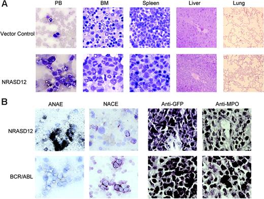 Figure 4. Hematopathologic, cytochemical, and histoimmunologic analysis of the N-RasD12–induced AML-like disease in mice. (A) Hematopathologic analysis of affected tissues in a representative NRASD12 mouse that succumbed to AML-like disease. Peripheral blood smears, bone marrow smears, and spleen touch preparations (from left to right) from vector control (top row) and a NRASD12 mouse (bottom row) were stained with the HEMA3 stains. Original magnification was × 630. Paraffin sections of liver and lung (rightmost columns) from vector control and NRASD12 mice were stained with hematoxylin and eosin. Images are magnified × 200. (B) Esterase staining for specific and nonspecific esterases (the left 2 columns) on WBCs from a diseased NRASD12 (top row) and a BCR-ABL (bottom row) mouse. The right 2 columns show a histoimmunochemical analysis of spleen sections from a diseased NRASD12 mouse with AML-like disease and a BCR-ABL mouse with CML-like disease, with anti-GFP (staining for leukemic cells) and anti-MPO antibodies, as indicated.