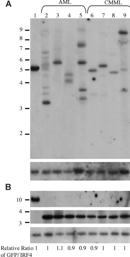 Figure 6. Analysis of NRASD12 proviral integration in AML and CMML tissues. (A) For analysis of NRASD12 proviral integration in diseased mice, genomic DNA from the livers of NRASD12 mice that succumbed to AML-like disease (lanes 2-5) and CMML-like disease (lanes 6-9) was digested with BglII and probed with a 0.7-kb 32P-labeled GFP probe. Lane 1 is a control to establish levels of a single copy of the provirus. The blot was then stripped and reprobed with a 1.4-kb 32P-labeled irf4 probe as a loading control (bottom). (B) Genomic DNA was digested with XbaI, which cuts within the LTRs, to show intactness of the provirus. The top panel shows the MSCV-BCR/ABL-IRES-GFP single copy provirus control, which is larger in size than the RAS provirus. The blot was stripped and reprobed with an irf4 probe as a loading control (bottom). The relative ratios of proviral DNA to the irf4 loading control as compared with that of the cell line control are shown.