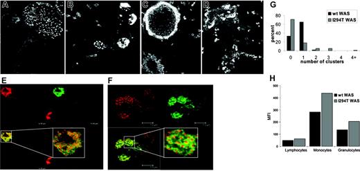 Figure 3. Macrophages from P1 had abnormal podosome clustering and increased levels of F-actin. (A) Normal macrophages were polarized with podosomes evenly distributed at the leading edge. (B-D) Macrophages from P1 exhibited a loss of polarization and uneven podosome distribution; typically podosomes were found in multiple clusters or ring structures. (E and F) Staining with antivinculin antibody revealed a ring of vinculin around an actin core for both normal and patient cells, respectively. Insets show a magnified view of an individual podosome. (G) Quantification of podosome clusters per cell. (H) Quantification of F-actin in normal and patient cells.