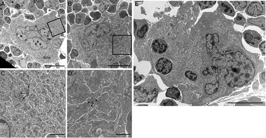 Figure 3. Ultrastructural defects of Scl–/Δ megakaryocytes. Transmission electron microscopic (TEM) images of representative megakaryocytes present in the bone marrow of Scl+/Δ (A) and Scl–/Δ (B) mice treated for 4 days with 2 μg PEG-rhTPO and analyzed on day 5. Panels C and D show magnified regions of panels A and B, respectively, as indicated by the boxed regions. Note the presence of alpha granules (g) in the cytoplasm of the Scl+/Δ megakaryocyte in panel C and depleted granules (g) in the cytoplasm of the Scl–/Δ megakaryocyte in panel D. (E) Example of a megakaryocyte from a TPO-treated Scl–/Δ mouse showing emperipolesis (3 cells contained within the cytoplasm). Nuclei (n) and demarcation membrane systems (dms) are indicated. Scale bars represent 10 μM (A-B, E) and 2 μM (C-D).