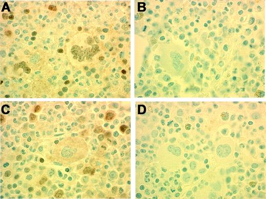 Figure 4. Immunohistochemical detection of p-STAT. Positive staining is present in nuclei of megakaryocytes and erythroid precursors (A) in a patient (Table 3, Patient no. 7) with RARS-T heterozygous for JAK2 V617F mutation (G/T). Negative antibody control (B). Positive staining is present in nuclei of erythroid precursors but absent in megakaryocytes (C) in a patient (Table 3, Patient no. 1) with RARS-T who lacks JAK2 V617F mutation. Negative antibody control (D). Original magnification, 100×.