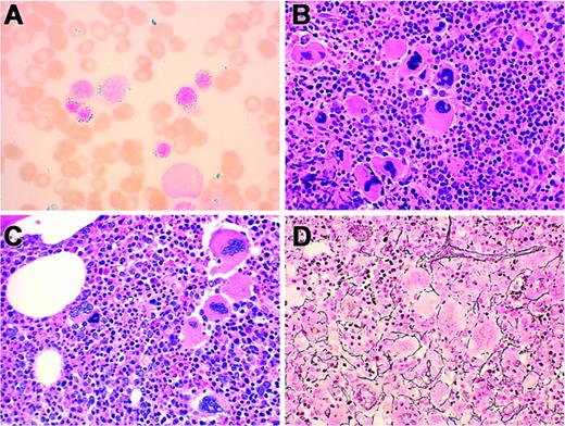 Figure 5. Pathologic features of RARS-T heterozygous for JAK2 V617F G/T mutation. (A) Bone marrow aspirate shows frequent ringed sideroblasts (Prussian blue stain, original magnification, × 100). (B, C) Bone marrow biopsies from different patients show hypercellularity with clustered megakaryocytes (H&E stain, original magnification × 40). (D) Bone marrow biopsy with increased stromal reticulin (2+/4+) (Gomori reticulum stain, original magnification, × 40). (Panels A, B, D: Table 3, Patient no. 5; Panel C: Table 3, Patient no. 3.)
