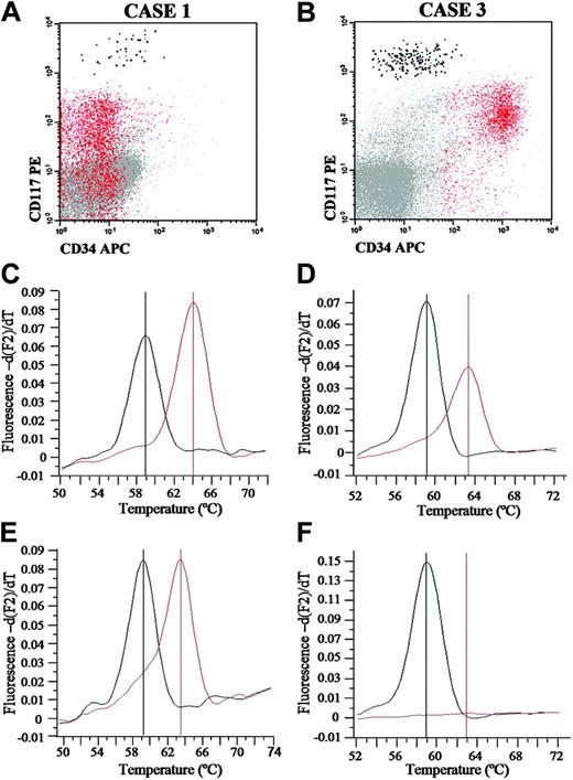Figure 2. Representative analysis of D816V KIT mutation in purified BM MCs and blast cells from 2 patients with SM-AHNMD. (A-B) Immunophenotypic characteristics of blast cells (red dots) and mast cells (black dots) in BM samples from patients 1 and 3 listed in Table 3, prior to FACS sorting. (C-F) Melting curves of wild-type (approximately 59°C; black line) and mutated (approximately 63°C; red line) KIT sequences from mast cells (C-D) and blast cells (E-F) from patients 1 (C-E) and 3 (D-F).