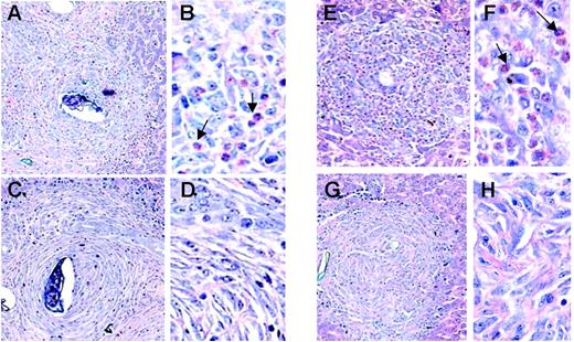Figure 4. Microscopic pathology of hepatic granulomata of S mansoni–infected wild-type and eosinophil lineage–ablated ΔdblGATA and TgPHIL mice. Giemsa-stained liver tissue sections featuring granulomata from S mansoni–infected BALB/c (A-B), ΔdblGATA (C-D), C57BL/6 (E-F), and TgPHIL (G-H) mice all at 12 weeks of infection. Arrows indicate examples of eosinophils. Original magnifications × 10 (A-B,E-F) and × 40 (C-D,G-H).