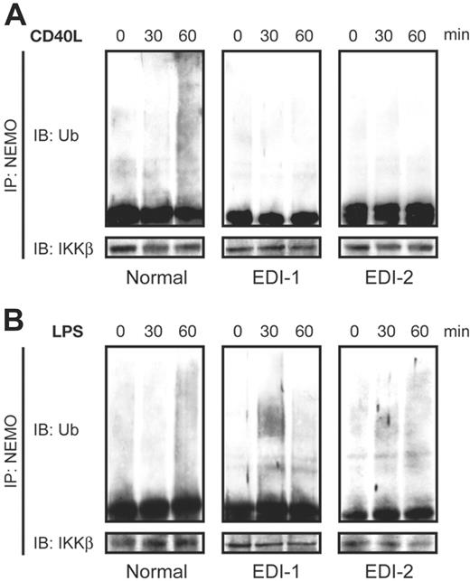Figure 2. K-63 polyubiquitination of C417R mutated NEMO is impaired in EDI MoDCs stimulated through CD40 but not through TLR4. (A) Polyubiquination of NEMO in response to CD40L (2.5 μg/mL) for the indicated time periods in normal and EDI MoDCs. (B) Polyubiquitination of NEMO when stimulated with LPS (2.5 μg/mL) for the indicated time periods in normal and EDI MoDCs. Cell lysates were immunoprecipitated (IP) with anti-NEMO monoclonal antibody and then analyzed with an anti-Ub antibody by immunoblotting (IB). The blot was reprobed with an anti-IKKβ antibody that served as a loading control.