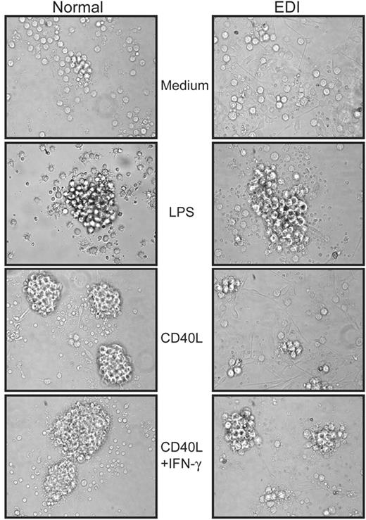 Figure 4. EDI MoDCs fail to form tight and dense clusters when stimulated with CD40L. After 24 hours of stimulation with CD40L (2.5 μg/mL), CD40L plus IFN-γ (2000 U/mL), or LPS (2.5 μg/mL), healthy control (left panel) and EDI patient (right panel) MoDCs were subjected to differential interference contrast (DIC) microscopy, and images were taken at 40 × magnification. One experiment of 2 is shown.