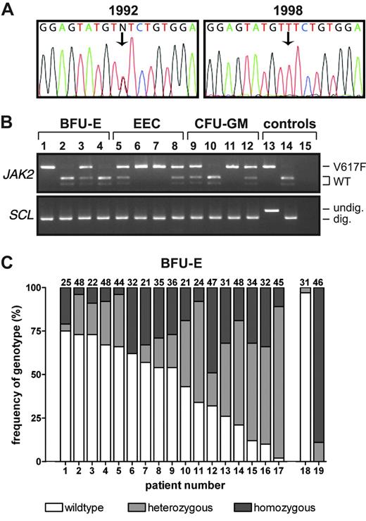 Figure 1. Frequency of V617F homozygosity in patients with PV. (A) JAK2 sequence analysis of granulocyte DNA samples from a patient with PV. Note the V617F-heterozygous sequence pattern in a sample from 1992, and a V617F-homozygous pattern in a sample from 1998. (B) BsaXI digestion of JAK2 exon 14 and SCL intron 1 was used to genotype DNA from BFU-Es, EECs and CFU-GMs cultured from PV patient 13. Lanes 1-4 indicate BFU-Es; lanes 5-8, EECs; lanes 9-12, CFU-GMs; lane 13, undigested granulocyte DNA from a V617F-negative control; lane 14, BsaXI-digested granulocyte DNA from a V617F-negative control; and lane 15, water. V617F-homozygous colonies are seen in lanes 1, 6, 7, and 11; heterozygous colonies are seen in lanes 3, 5, 8, 9, and 12. (C) Frequencies of wild-type, V617F-heterozygous, and V617F-homozygous peripheral blood BFU-Es in 17 PV patients with a heterozygous JAK2 granulocyte sequence trace were determined using PCR and BsaXI digestion. The absolute number of colonies genotyped from each patient is at the top of each column. Column 18 shows a V617F-positive PV patient with a wild-type sequence trace; column 19, a PV patient with a V617F-homozygous sequence trace.
