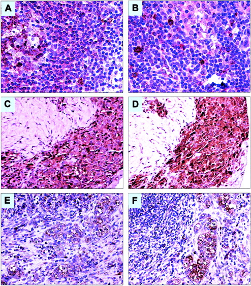 Figure 3. Expression of IL-9Rα and IL-9 in a reactive lymph node and in primary ALK+ ALCL tumors from patients. (A) IL-9Rα is strongly expressed in a significant number of cells within the germinal center (left side) and the mantle zone of a reactive lymph node. The frequency and intensity of expression of IL-9Rα are relatively diminished in the marginal zone and interfollicular areas (original magnification × 200). (B) IL-9 is strongly expressed in scattered small lymphoid cells and mast cells in a reactive lymph node. Most of these cells are localized in the interfollicular areas as well as around and within the lymph node sinuses (original magnification × 200). (C-D) An example of a lymph node showing sclerotic tissue with dense infiltration by ALK+ ALCL cells that are strongly positive for IL-9Rα (C) and IL-9 (D; original magnification × 200). (E-F) Another example of a lymph node involved by ALK+ ALCL demonstrating large neoplastic cells that are positive for IL-9Rα (E) and IL-9 (F). The large neoplastic cells are confined to the lymph node sinuses, a characteristic morphologic feature of ALK+ ALCL (original magnification × 200). In all of the tissue samples, the staining for both IL-9Rα and IL-9 was membranous and cytoplasmic, whereas the nuclei were negative for the 2 proteins.
