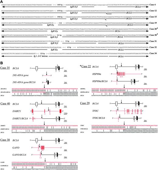 Figure 2. Characterization of the chromosomal junctions of the BCL6 translocations in gastric lymphoma. (A) Nucleotide sequences of the chromosomal junctions and breakpoints of Ig/BCL6 translocations. The overlapping nucleotides of the junction sequences of BCL6 and the fusion partners are doubly underlined. Variable numbers of nucleotides of unknown origin inserted at the breakpoints are shown in lowercase letters and are not underlined. The number within each bracket indicates the distance between the 2 nucleotides. (B) Schematic representation of the non-Ig/BCL6 translocations. ▪ and □ represent exons from BCL6 and the fusion partners, respectively. Vertical arrows indicate the chromosomal junctions and breakpoints of non-Ig/BCL6 fusion genes. The overlapping nucleotides of the junction sequences of BCL6 and the fusion partner genes are underlined. Open arrowheads indicate coding initiation start sites. *DLCLML cases.