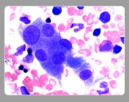 Figure 1. Osteoclasts are large multinucleated cells with granular cytoplasm. They may resemble megakaryocytes. Their nuclei, however, tend to be regular in shape and are separated by areas of cytoplasm. . / Peter Maslak, Memorial Sloan-Kettering Cancer Center