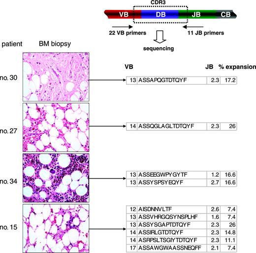 Figure 2. Examples of the application of TCR multiplex PCR for detection of immunodominant clonotypes in BM biopsies. Multiplex VB PCR combined with clonotype sequencing allowed for the detection of immunodominant clonotypic expansions in archived bone marrow biopsies. VB indicates T-cell receptor VB chain; CDR3, complementarity determining region 3; JB, joining region of the TCR B chain; and CB, constant B chain. All immunodominant BM-derived clonotypes are shown in Table 7. Images were obtained via digital microscopy using an Olympus BX41 microscope (Olympus America, Melville, NY) equipped with a 40×/0.75 NA UPlan objective lens. Slides were stained with hematoxylin and eosin. Images were captured using a Digital Camera Model no. 11.2 Color Mosaic (Diagnostic Instruments, Sterling Heights, MI), and imaging software included Spot Basic 4.1.3 (Diagnostic Instruments).