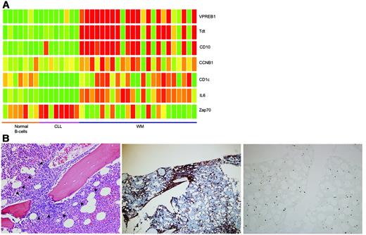 Figure 2. Contributions of genes from contaminating cell populations. (A) Closer inspection of some of the genes within the gene cluster overexpressed in normal B cells, CLL, and WM revealed some interesting differences. In particular, the concurrent overexpression of NPTT (tdt), MME (CD10), and VPREB1 in the WM samples suggested likely contamination with pre-B cells. In addition, ZAP70 and CCNB1 (as a representative gene from the proliferation cluster overexpressed in a subset of patients with WM) overexpression is tightly associated with samples overexpressing NPTT (tdt), MME (CD10), and VPREB1. (B) To verify that tdt expression was originating from contaminating pre-B cells, immunostaining for tdt was performed on BM biopsies from patients with WM with and without the pre-B-cell contamination signature. This figure is representative for samples with the contamination signature. Malignant cells (CD20+) formed intramedullary clusters (marked by arrows; left panel, hematoxylin and eosin staining; middle panel, CD20 staining). In contrast, nuclear tdt staining was seen in scattered interstitial cells that represented pre-B cells (right panel). In samples without the contamination signature, no tdt+ cells were seen. All images were acquired using a 40×/0.8 numeric aperture objective lens. The microscope used is a Zeiss Axioskop (Carl Zeiss Microimaging, Thornwood, NY). Images were captured by the Olympus DP70 CCD camera using DP controller image capture software (Olympus, Center Valley, PA).