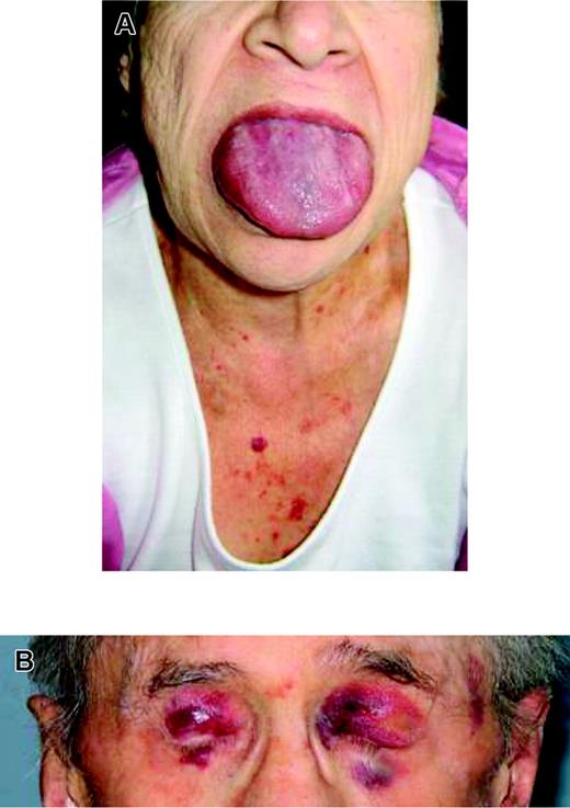 Figure 3. Prototypic physical findings in AL. (A) A patient with macroglossia and purpura. Macroglossia is observed in 12% of patients with AL. (B) Periorbital purpura exacerbated by the Valsalva maneuver is seen in 6% of patients.