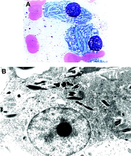 Figure 6. Crystalloid cytoplasmic inclusions in bone marrow plasma cells of a patient with Fanconi syndrome. A 70-year-old woman with indolent myeloma (IgGκ) developed mild renal failure. Bone marrow examination showed 17% plasmacytosis. The light microscopic (A) (Wright stain; original magnification, × 1000) and electron microscopic (B) (original magnification, × 13 680) photographs of marrow plasma cells displayed crescent-shaped cytoplasmic inclusions. The patient had low levels of serum bicarbonate and uric acid and elevated urine lysozyme (see Phillips et al70).