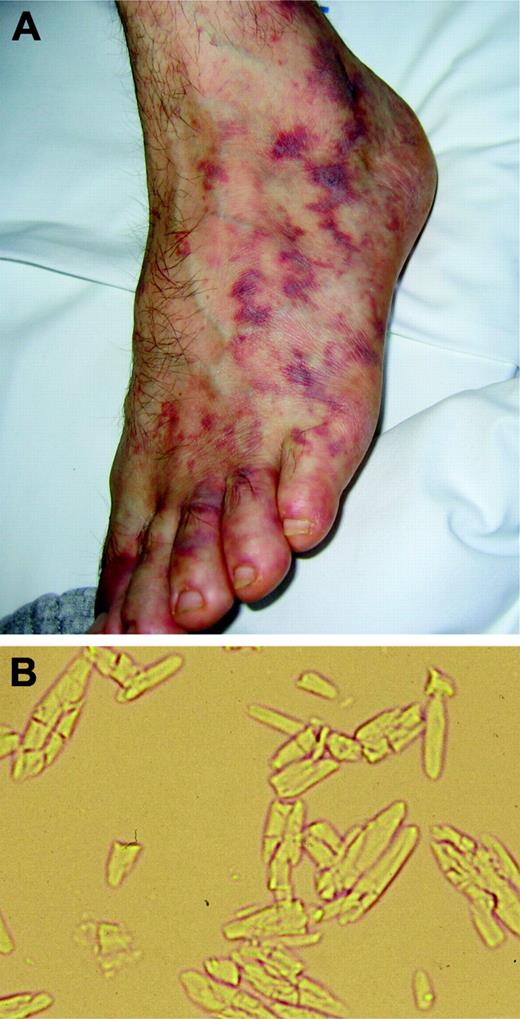 Figure 7. Features of cryocrystalglobulinemia. (A) Painful vasculitis produced by an IgGκ cryocrystalglobulin. Plasmapheresis rapidly resolved the vasculitis, and subsequent treatment with high-dose dexamethasone significantly reduced (by 70%) the concentration of the monoclonal IgGκ, leading to complete clinical remission. (B) Crystals formed after storing the serum at 4°C for 24 hours. Image was visualized using a Nikon Eclipse E600 microscope equipped with a Nikon Pan Fluor 20 ×/0.50 NA objective with no staining. Image was acquired using a Leica DFC 480 camera and Leica IM50 Image Manager software.