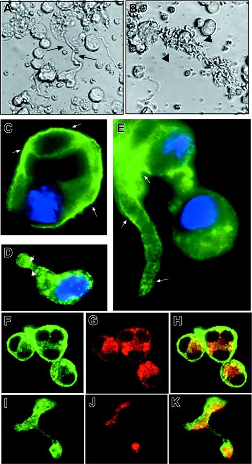 Figure 3. Phase-contrast and immunofluorescence analysis of megakaryocytes cultured in vitro from CD34+ peripheral blood samples from patient 1. (A) Phase-contrast microscopy shows that megakaryocytes from a control donor at day 12 of culture have typical long and discrete proplatelets (arrows). (B) In contrast, megakaryocytes from patient 1 give rise to proplatelets that are intertwined (arrowheads). (C-E) Fixed and permeabilized cells from the patient were subjected to immunofluorescence labeling for VWF (green). Results show that at day 12 for the patient, VWF has both intracellular and surface staining (white arrows). Nuclei are shown in blue by DAPI. (F-K) Confocal microscopy shows the distribution of VWF and P-selectin in cultured megakaryocytes from patient 1. Cells taken at day 12 were fixed and permeabilized prior to being labeled for VWF (green fluorescence) (F,I) and P-selectin (red fluorescence) (G,J). When the colors were merged (H,K), much of the VWF has a different localization to the α-granule marker, P-selectin, with the labeling for VWF clearly extending to the surface of the cell. Images were acquired using a 63 ×/1.4 NA oil objective.
