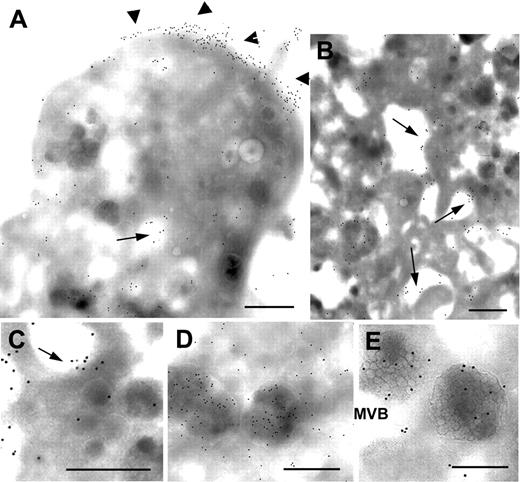 Figure 4. Immunogold labeling of VWF on cultured cells. Megakaryocytes at day 12 from cultures of CD34+ cells isolated from the peripheral blood of patient 1 were fixed, and frozen thin sections were stained sequentially using a polyclonal anti-VWF antibody and a secondary antibody to rabbit IgG adsorbed onto 10-nm gold beads. Transmission electron microscopy revealed that VWF was present on the cell surface (arrowheads, panel A) as well as in intracellular canals (arrows, panels A-C) and in well-developed α-granules (D-E). Multivesicular bodies (MVB) are seen in panel E. Scale bars equal 500 nm.