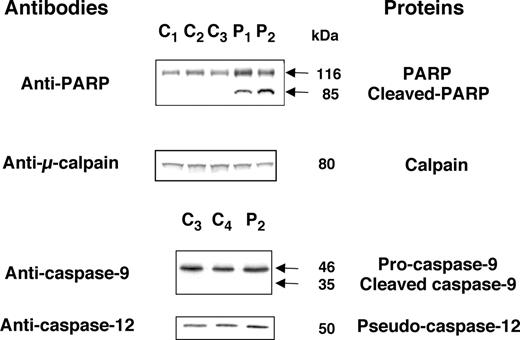 Figure 7. Platelets of the patients exhibit abnormal caspase-3 processing.Proteins from the same samples as those used in Figure 5 were subjected to WB using the antibodies indicated to detect the expression of proteins involved in the apoptotic pathways. Data are typical of 3 independent experiments.