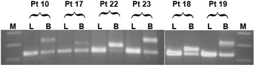 Figure 1. Extent of lineage involvement of FLT3/ITD. Flow-sorted lymphocytes (L) and myeloblasts (B) from 12 patients positive for FLT3/ITD were tested for the presence of FLT3/ITD mutations; results from 6 patients are displayed. The first 4 patients (patients 10, 17, 22, and 23) had FLT3/ITD involvement of both CD34+/CD33--derived CFU-GM and BFU-E colonies. Patients 18 and 19 had FLT3/ITD involvement of CD34+/CD33- CFU-GM colonies only. M indicates molecular weight marker.