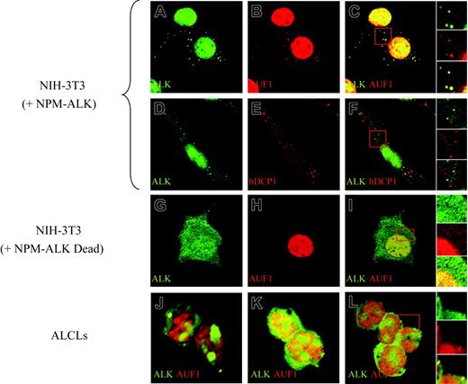 Figure 4. NPM-ALK and AUF1 colocalize in cytoplasmic granules. Permeabilized NPM-ALK NIH3T3 and ALCL-derived cells were incubated with monoclonal anti-ALK and/or polyclonal anti-AUF1 or hDCP1 serum, as indicated. AUF1 and NPM-ALK are found in cytoplasmic foci (A-B) that fully colocalize (panel C and magnification of the insert in the right panels). These cytoplasmic foci do not correspond to P-bodies recognized by a polyclonal anti-hDCP1 serum (E), as NPM-ALK-labeled granules (D) and P-bodies (E) do not overlap (panel F and magnification of the insert in the right panel insert). NPM-ALK tyrosine kinase activity is required for granule formation, as granules are not observed in NIH3T3 cells expressing a NPM-ALK kinase-defective mutant (G-I). Colocalization of NPM-ALK and AUF1 is also observed in NPM-ALK-expressing ALCL-derived cells (Karpas, panel J; SU-DHL1, panel K; and COST, panel L and magnification of the insert in the right panel).