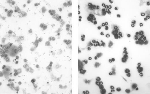 Figure 1. Myeloablative effectiveness of the irradiation protocol before BMT. These are light micrographs of bone marrow cytospin preparations. Mouse bone marrow was isolated and layered onto discontinuous Percoll (Sigma-Aldrich) gradient of 82%/65%/55%. Neutrophils were recovered at the 82%/65% interface, and cytospin preparations were subsequently prepared and stained using the Wright-Giemsa method. The left panel shows mouse bone marrow neutrophils 1 week after irradiation without BMT rescue, and the right panel shows mouse bone marrow neutrophils from a healthy control mouse. These micrographs demonstrate the effectiveness of our radiation protocol in depleting the recipient's immune system in preparation for donor BMT. Original magnification, × 40.