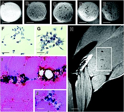 Figure 6. T2-weighted images of phantoms and injected muscle leg tissues and implanted CD133+ stem cells. MR images of phantoms formed by a set of test tubes containing a suspension of Endorem-labeled cells in gelatin: (A) 500, (B) 5000, (C) 20 000, (D) 50 000, and (E) 100 000 cells. Sample contains gelatin only. Inhomogeneities in the phantom images were caused by the moderate sedimentation of cells while the gelatin was setting. Sequence parameters were repetition time (TR), 2000 msec; effective echo time (TE), 42.5 msec; turbo factor, 4; number of acquisitions (AC), 16; field of view (FOV), 3.5 cm; matrix, 256 × 256; slice thickness, 0.5 mm; slice separation, 1 mm. Two sets of interleaved transversal images were measured to cover the whole muscle. For in vitro experiments, phantoms of sterile agarose 2% containing labeled cells were measured by a similar sequence with different geometry: FOV, 6 cm; matrix, 256 × 256; slice thickness, 1 mm. Only one slice was measured for phantoms. Prussian blue staining of samples containing 50 000 (F) and 100 000 (G) cells. (H) Several areas of hypointense signal were seen 24 hours after intra-arterial grafting by MRI (white quadrant). (J) Histologic examination performed on biopsy specimens of MRI-positive areas confirmed positive Prussian blue-stained cells that coexpressed the CD133 antigen around muscle vessels. Scale bars represent 100 μm (A-E); 25 μm (F-G, I, inset); 3 mm (H).