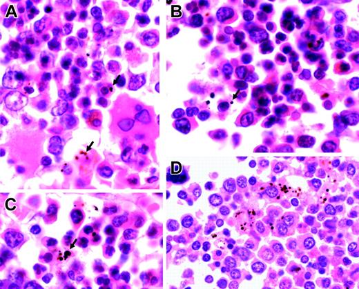 Figure 5. Representative sections of bone marrow from children with severe malarial anemia. (A-C) Highly abnormal erythropoiesis (irregular, bi-, and multinucleated erythroid cells) in association with Hz (arrows). (D) Hz predominantly inside myeloid cells (hematoxylin and eosin staining; original magnification, × 1000). Cells were viewed with a Nikon Eclipse E600 microscope equipped with a Nikon 100 ×/1.40 numeric aperture oil-immersion objective lens (Nikon, Surrey, United Kingdom) and a Zeiss Axiocam (Zeiss, Göttingen, Germany). Axiovision 3 software (Zeiss) was used to acquire images, and ImageJ software (http://rsb.info.nih.gov/ij) was used to process them.