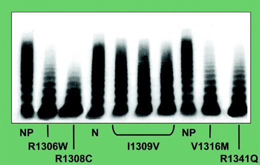 Multimeric structure of plasma VWF in selected patients with type 2B VWD and different VWF mutations as obtained by low-resolution SDS agarose gel electrophoresis. Two normal samples (NP) are shown for comparison. The cathode is at the top of the figure, and the direction of electrophoretic migration is from top to the bottom. Adapted from Federici et al. 3