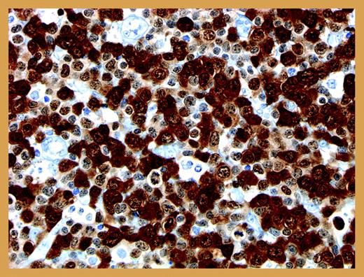Anti-ALK immunostain of a typical NPM-ALK-positive anaplastic large-cell lymphoma. Illustration by Dr Mihaela Onciu, St Jude Children's Research Hospital.
