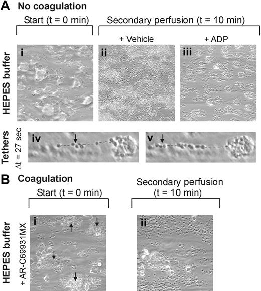 Figure 2. Key role of ADP receptor in thrombus stability in the absence and presence of coagulation. (A) Human PPACK-anticoagulated blood was flowed over VWF/collagen at 1000 s–1 for 4 minutes. Thrombi were formed on coverslips (i). These were perfused again for 10 minutes with HEPES buffer (pH 7.45) containing 2 mM CaCl2 and 2 mM MgCl2. Vehicle (ii) or ADP (20 μM) (iii) was added during secondary perfusion. Representative phase-contrast images (180 × 180 μm) are given after 10 minutes. Strings of platelets connected by tethers (dotted line) detaching during 27 seconds of perfusion (iv-v). (B) Citrated blood was recalcified with CaCl2/MgCl2 before flow over VWF/collagen at 1000 s–1. Fibrin-containing thrombi on coverslips were perfused again for 10 minutes with the same HEPES buffer supplemented with AR-C69931MX (30 μM) (Video S3). Representative phase-contrast images are given of 1 field before and after secondary perfusion (i-ii). Note dissolution of all but one of the fibrin-containing thrombi. Arrows indicate fibrin-containing thrombi. Shown are representative images (n = 3-5 experiments).