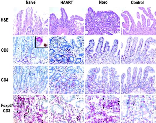 Figure 3. Representative immunohistochemical analysis of T-cell subsets in duodenal mucosa. Tregs (arrows, bottom row), identified by double immunoenzymatic labeling for CD3 (red, membranous) and FOXP3 (brown, nuclear), showed a dramatic increase in untreated HIV-infected patients. Inset: CD8+ T cell (red) without expression of FOXP3 (brown). Original magnification ×200, ×400 (bottom row), and × 600 (inset). Microscope: Olympus AX70. Numerical aperture of objective lenses: ×20, 0.70 mm; ×40, 0.95; ×60, 1.40. Stains: hematoxylin and eosin (top panel only); APAAP and immunoperoxide. Camera: JVC KY-F70 (JVC). Acquisition software: DISKUS. Software used for image processing: Adobe Photoshop 7.0 (Adobe Systems, San Jose, CA).