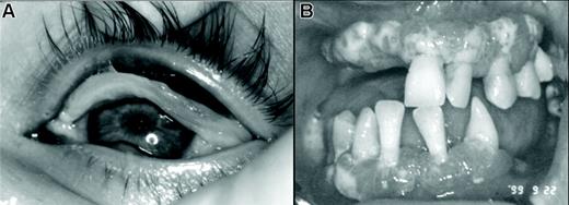 Figure 2. Clinical manifestations of type I PLG deficiency. (A) Ligneous conjunctivitis of the left upper eyelid in one of our patients. (B) Ligneous gingivitis with partial loss of teeth in one of our patients.