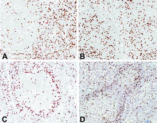 Figure 1. Immunohistochemical FOXP3-positive Treg patterns. (A) Interfollicular pattern. (B) Follicular pattern. (C) Perifollicular pattern. (D) Mixed pattern.