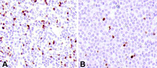 Figure 2. Tregs in FL and DLBCL. (A) FL at diagnosis. (B) The lymph node biopsy of the same patient at relapse shows a transformed DLBCL with a lower number of Tregs.