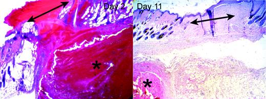 Figure 4. Hematomas adjacent to wounds in HB mice. HB mice developed hematomas (indicated by asterisks) in the subcutaneous tissues in the vicinity of the wound site (indicated by double-headed arrows). The left panel shows an example of a hematoma underlying the site of a 2-day-old wound. The right panel shows a completely healed 11-day wound, with a persistent hematoma in the subcutis. Original magnifications were × 40 (10 × ocular/4 × objective, NA = 0.13).