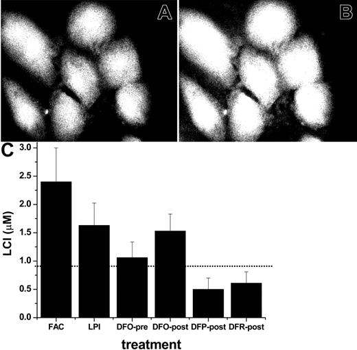 Figure 3. Effect of iron-loaded sera and chelators on cytosolic labile cell iron pools of primary cardiomyocytes. Cardiomyocytes grown for 6 days in culture were incubated for 20 hours in media containing either 30% normal human serum or 30% serum from an iron-overloaded patient containing (final) LPI of approximately 2 μM or in medium containing 10% fetal calf and 10% horse serum and 50 μM FAC. Cells were loaded with CALB-AM in DMEM medium without serum or pH indicator dye as described in “Materials and methods,” and LCI was either estimated by epifluorescence microscopy and digital image analysis (A, B) or quantified in a fluorescence plate reader (C). The upper panel depicts CALB fluorescence in cells pre-incubated for 20 hours with 50 μM FAC in growth medium, then loaded with CALB and photographed before (A) and after (B) addition of 50 μM SIH. The 45% rise in fluorescence elicited by SIH corresponds to a LCI pool of 2.5 ± 0.8 μM, determined in a fluorescence plate reader, as described previously.41 The lower panel (C) depicts the values of LCI pools based on measurements in a fluorescence plate reader. The bars represent LCI pools in cells incubated for 20 hours in growth medium containing FAC: 50 μM in standard growth medium with 10% fetal calf serum, 10% horse serum; LPI: 30% LPI-containing serum from an iron-overloaded patient with no additions; DFO-pre: 30% LPI-containing serum supplemented with 10 μM DFO from the onset of 20 hours of incubation; DFO-post, DFP-post, and DFR-post: 30% LPI-containing serum, which was supplemented with 10 μM DFO or 100 μM DFP or 100 μM DFR at the conclusion of the 20-hour preincubation, 20 minutes before loading with CALB-AM. LCI denotes mean labile cell iron pool values with standard deviations obtained with 5 experimental cell systems run in parallel, calculated as mean intensity values immediately before and 10 minutes after addition of 50 μM SIH, as described elsewhere.41 The dotted line represents the LCI of cells exposed to standard growth medium containing 10% fetal calf serum and 10% horse serum.