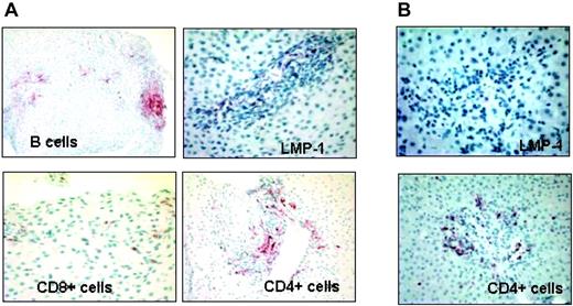 Figure 7. In vivo antitumor activity of EBV-CTL therapy. Patient no. 3 received EBV-CTLs containing greater than 90% of CD3+CD4+ T cells. Eight weeks after the infusion, for an increase of liver enzymes, a biopsy was performed to exclude the occurrence of graft rejection (A). Immunohistochemistry analysis shows presence of B cells positive for LMP1 (top panels) and massive infiltration of CD4+ T cells, surrounding the EBV-positive areas (bottom panels), suggesting the specific homing of CTLs in the tumor area. (B) Biopsy at resolution: no LMP1-positive cells are detectable. Images were acquired with a Zeiss Axioskop microscope (Carl Zeiss, Gottingen, Germany) with a 20×/0.50 NA Neofluor objective lens. Cells were stained with hematoxylin (Mayer)–eosin. Images were photographed with a Spotmatic RT camera and processed with Spotmatic 3.4 PC/3.3.2 (Diagnostic Instruments, Sterling Heights, MI).